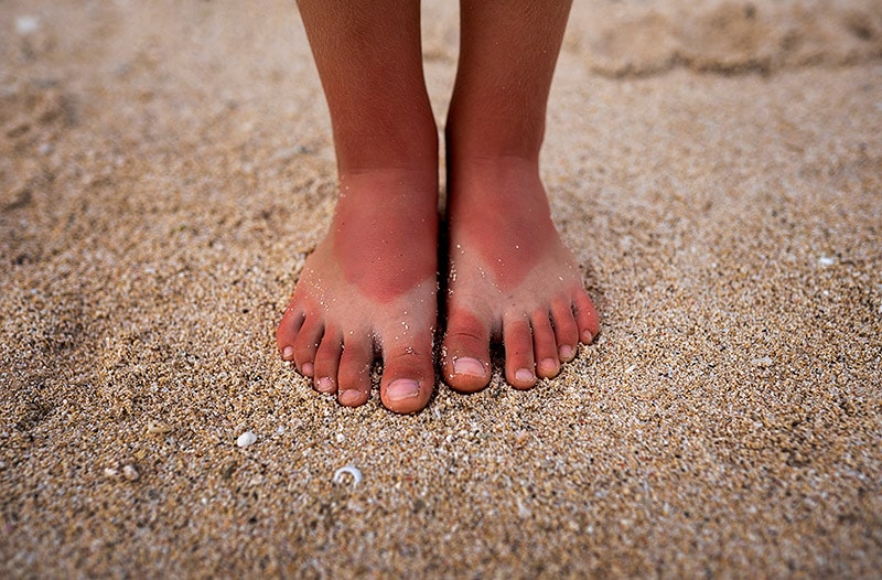 油断大敵！ 夏の日焼け、みんなの「やらかし体験」大公開