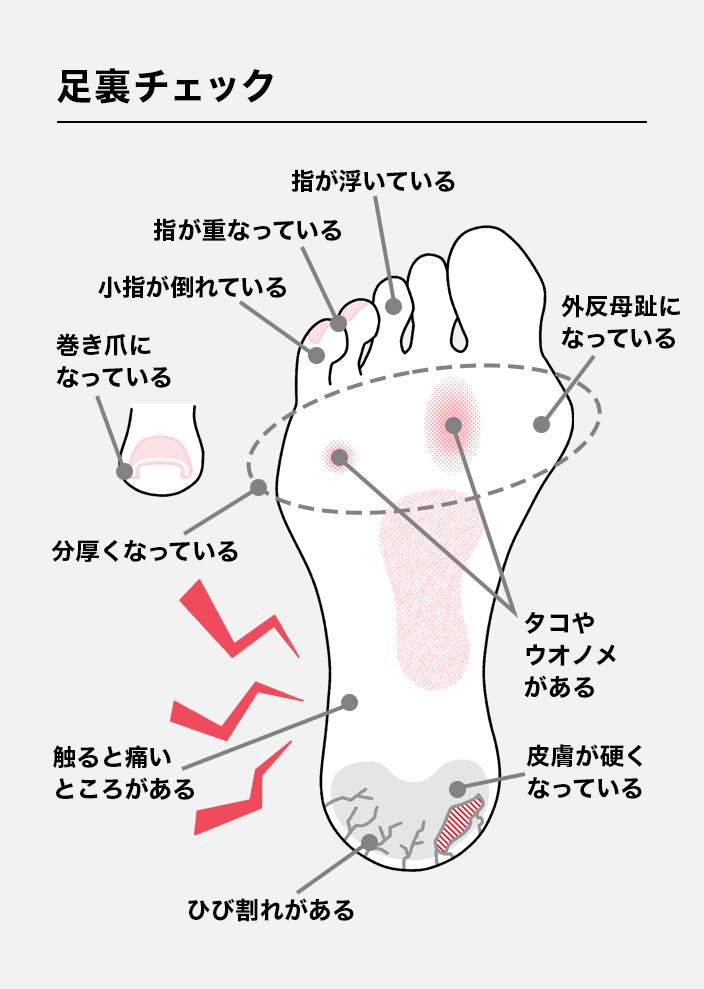 足裏診断：指が浮いている、指が重なっている、小指が倒れている、分厚くなっている、巻き爪になっている、触ると痛いところがある、ひび割れがある、皮膚が硬くなっている、タコやウオノメがある、外反母趾になっている
